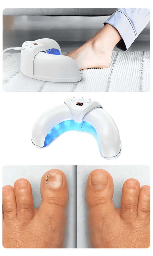 Fungabeam Nail fungus